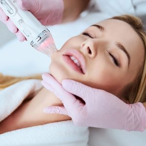 Fractional RF Micro needling Treatment - Introduction